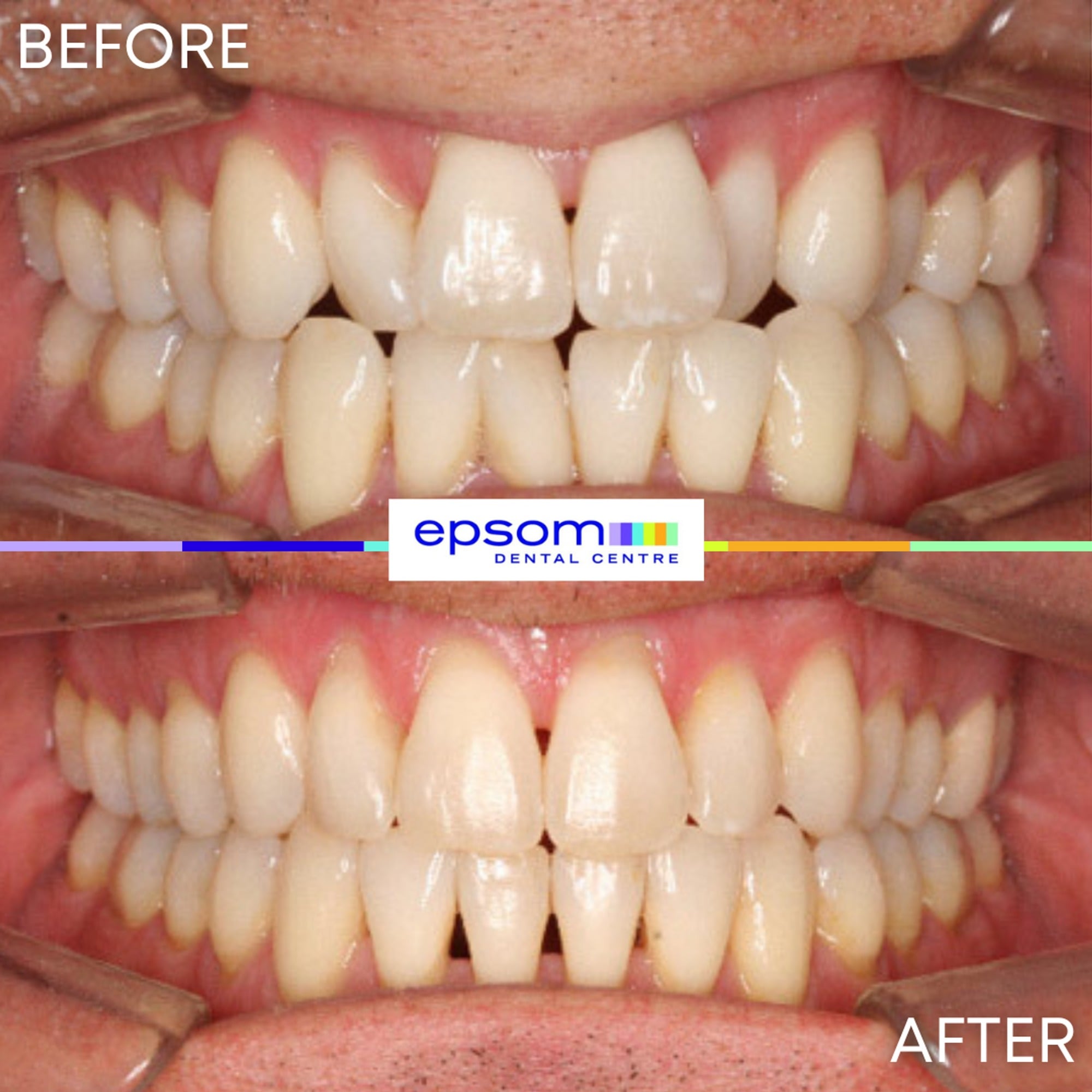 Before and after treatment
