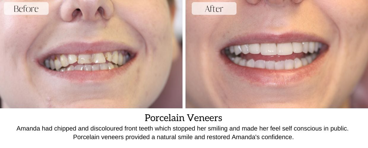 Before And After Smile Gallery at Epsom Dental Centre