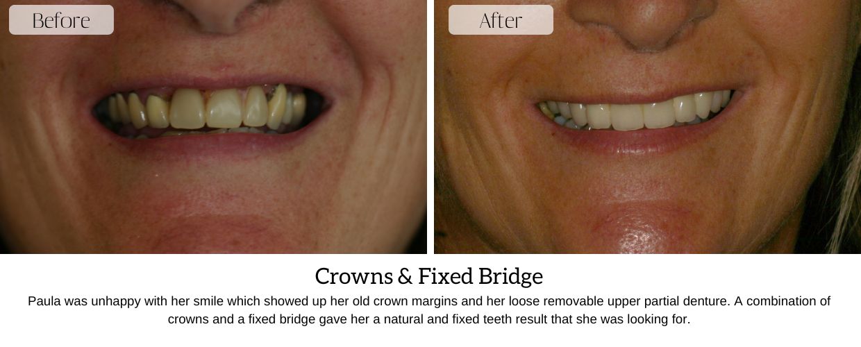 Before And After Smile Gallery at Epsom Dental Centre
