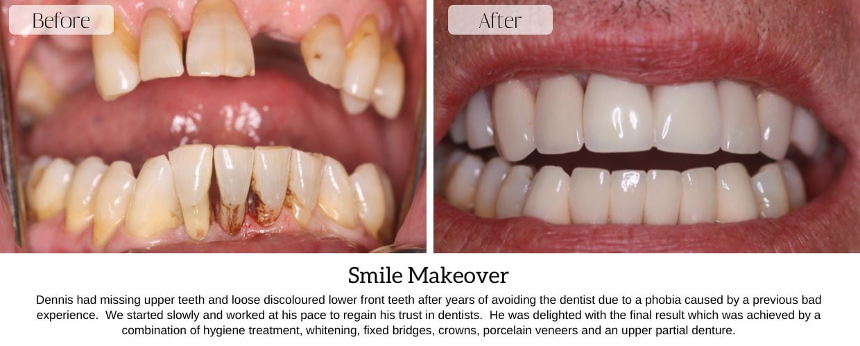 Before And After Smile Gallery at Epsom Dental Centre
