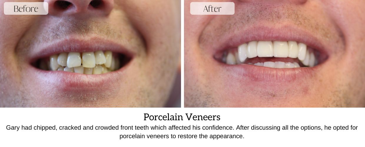 Before And After Smile Gallery at Epsom Dental Centre