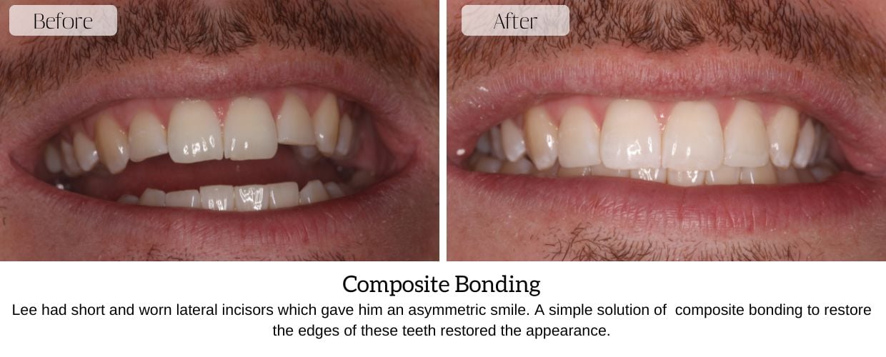 Before And After Smile Gallery at Epsom Dental Centre