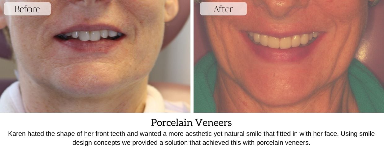 Before And After Smile Gallery at Epsom Dental Centre