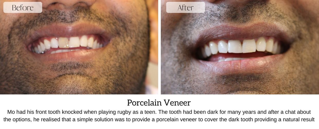 Before And After Smile Gallery at Epsom Dental Centre