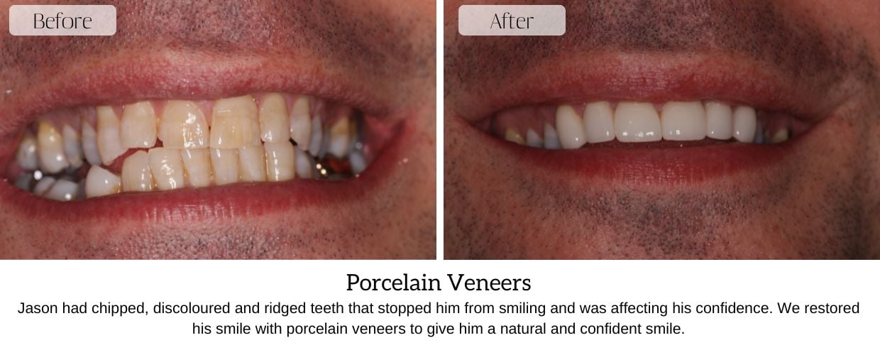 Before And After Smile Gallery at Epsom Dental Centre