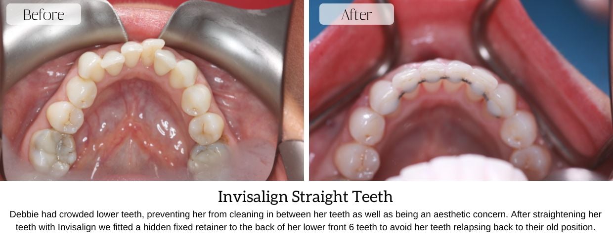 Before And After Smile Gallery at Epsom Dental Centre