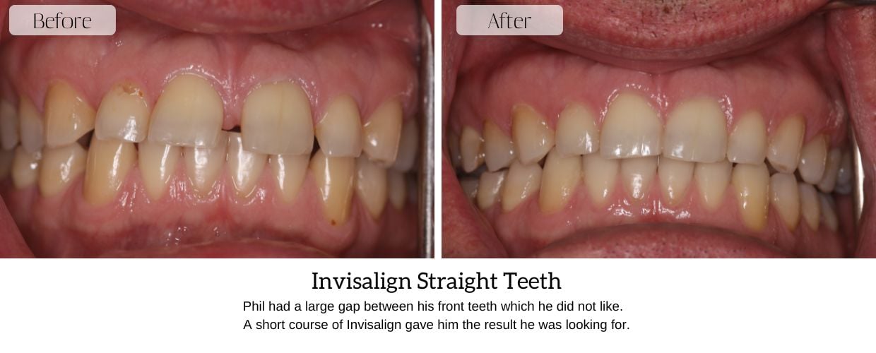 Before And After Smile Gallery at Epsom Dental Centre