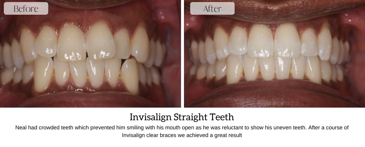 Before And After Smile Gallery at Epsom Dental Centre