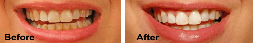 tooth whitening before and after