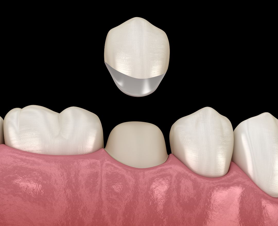 How Do Crowns Work