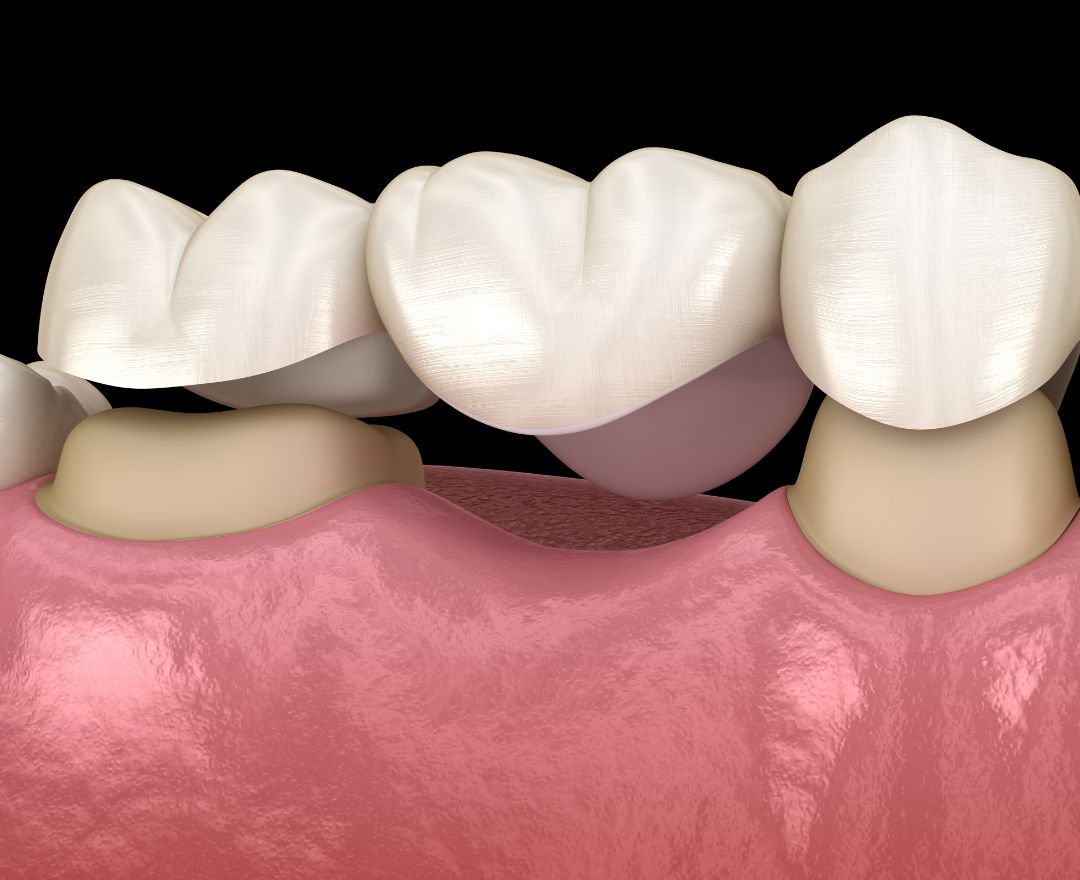 How Do Crowns Work