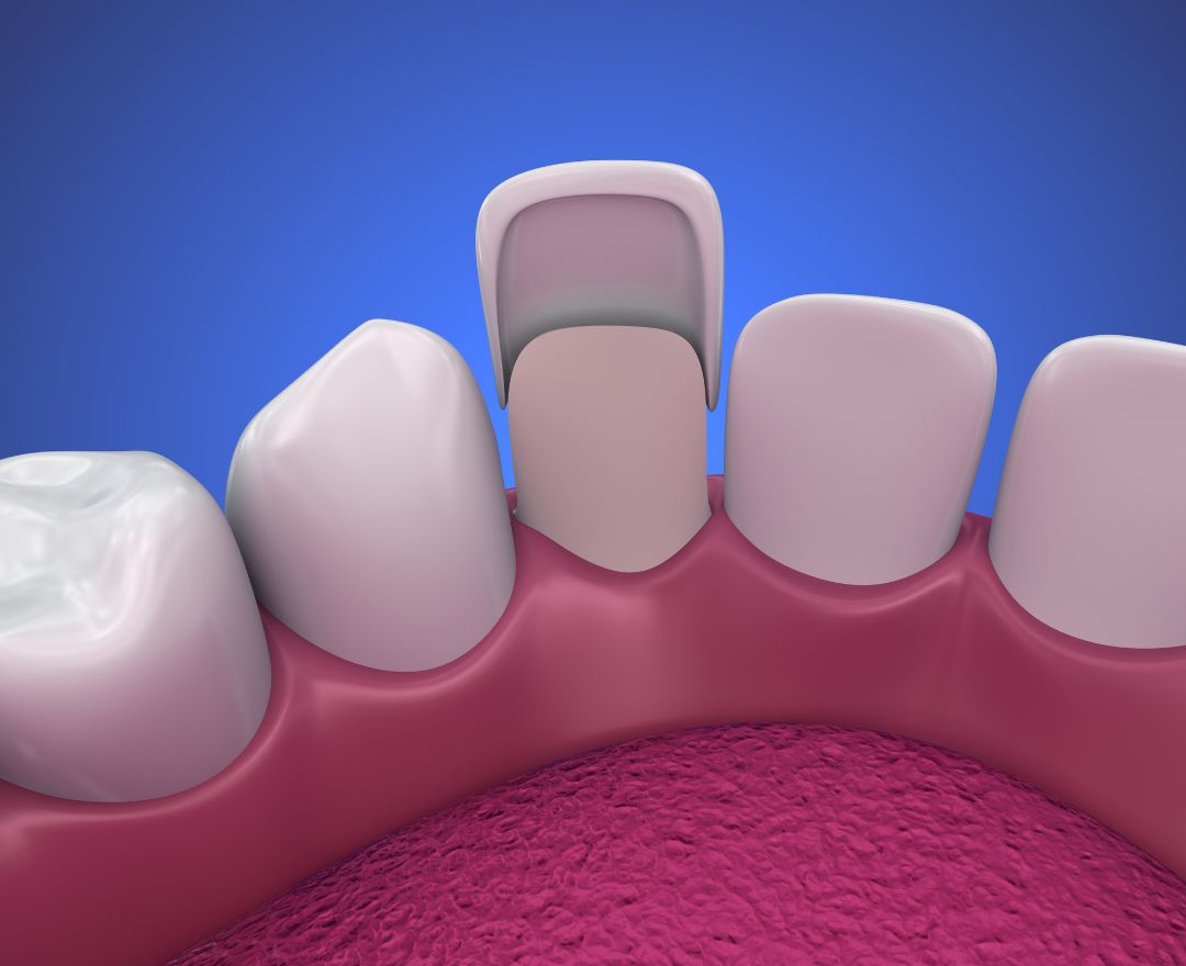Dental Veneers