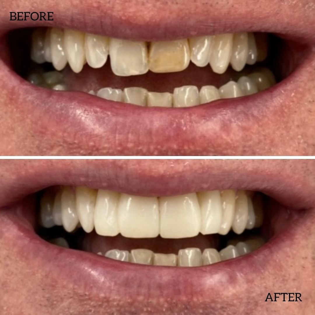 Before And After Composite Bonding Treatment