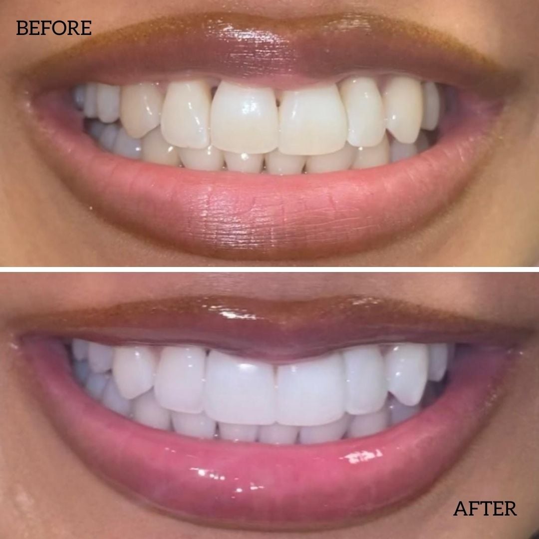 Before And After Composite Bonding Treatment