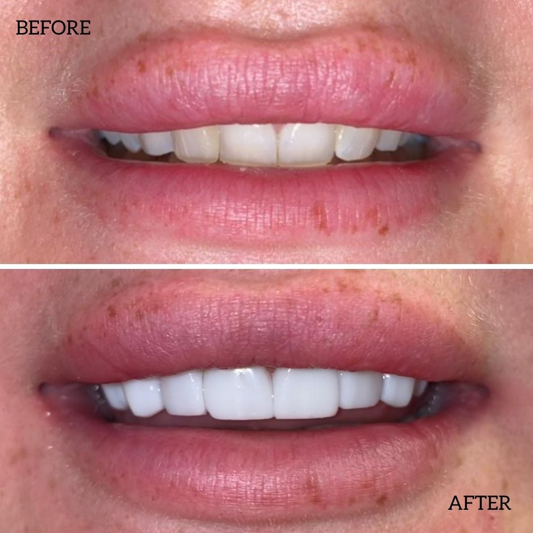 Before And After Composite Bonding Treatment