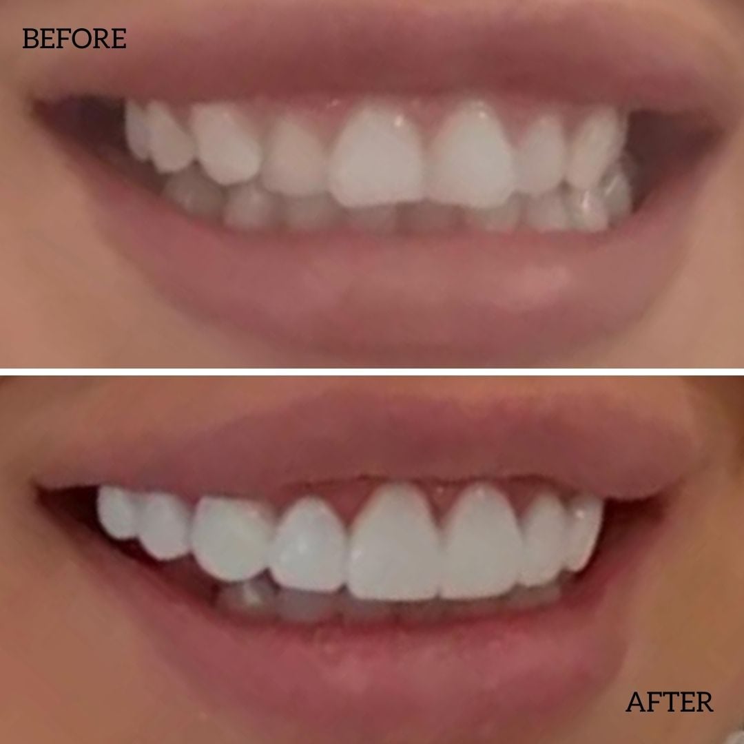 Before And After Composite Bonding Treatment