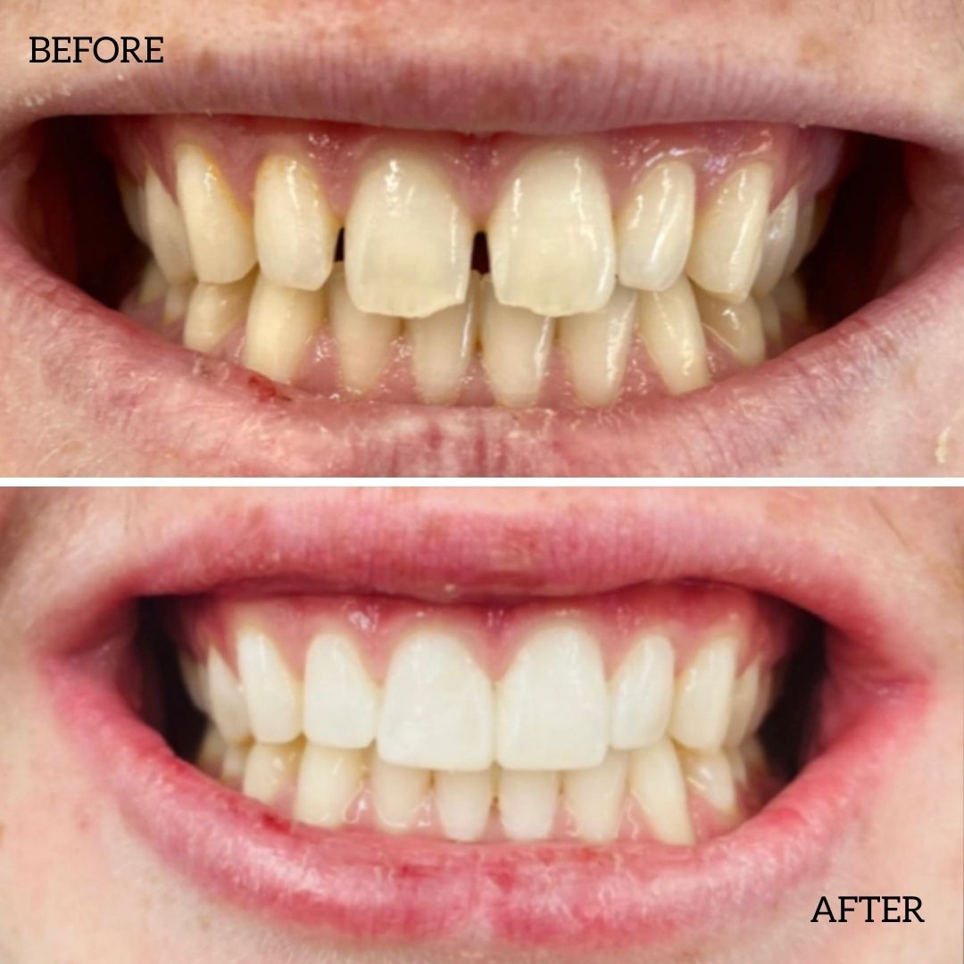 Before And After Composite Bonding Treatment